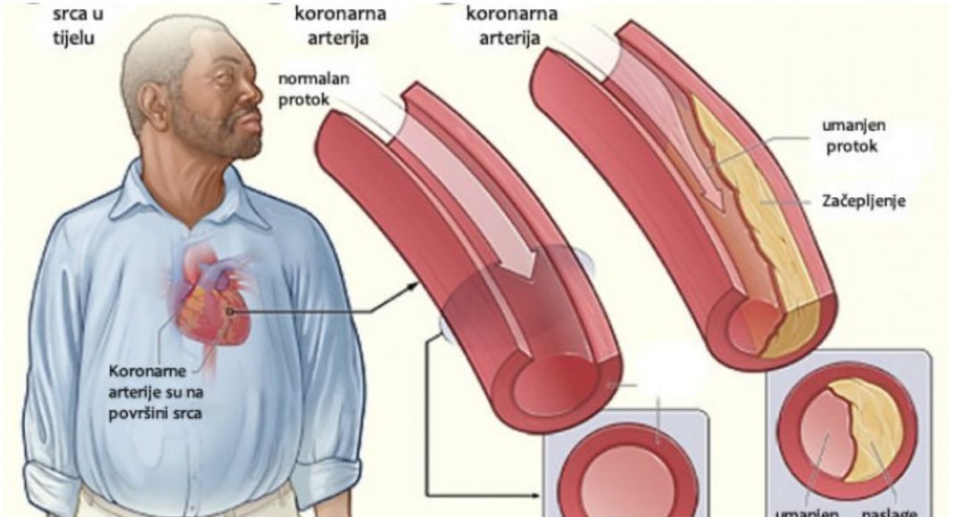 Ljekoviti napitak od češnjaka i limuna za čišćenje arterija