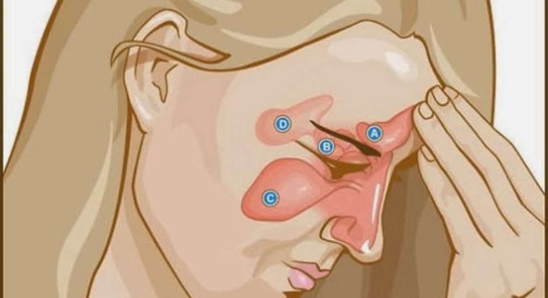 Bol u sinusima: Prirodni lijekovi