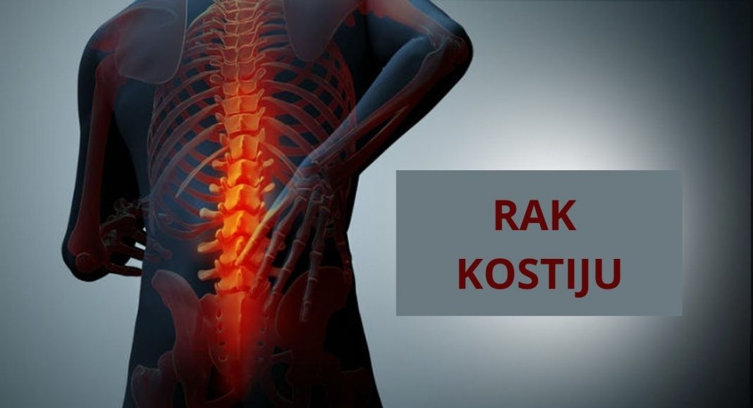 Rak kostiju