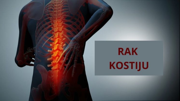 Rak Kostiju: Simptomi, Liječenje I Sve što Trebate Znati